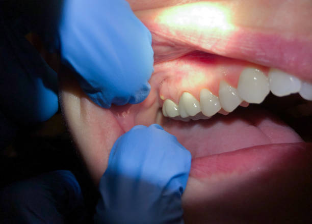 Best Emergency Wisdom Teeth Removal in North Randall, OH